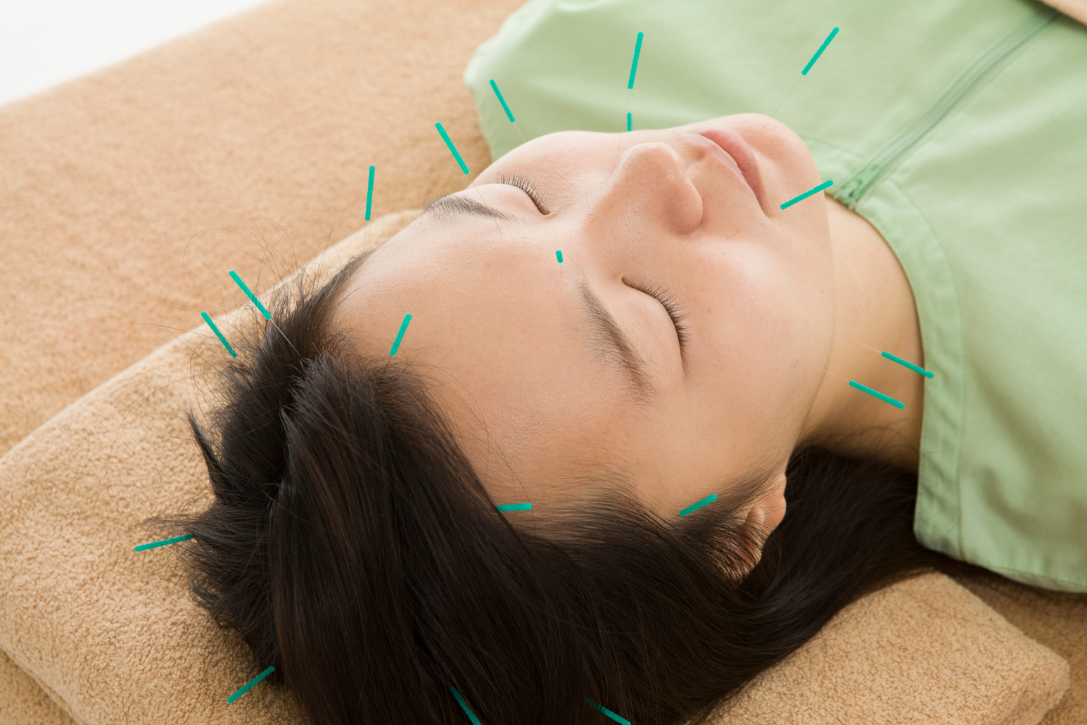 Beauty acupuncture
